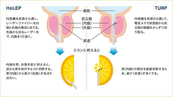 HoLEPと従来のTURPの違い