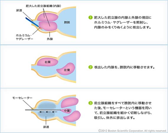 HoLEPの手順