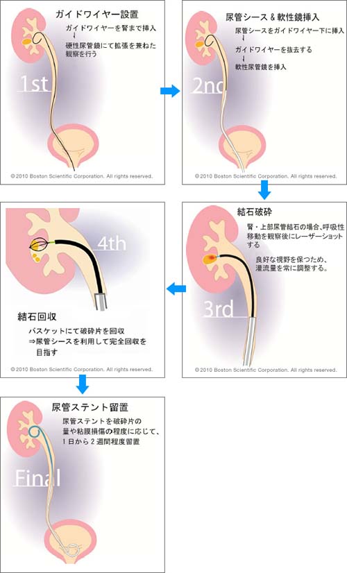 f-TUL手順