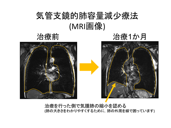 肺容量減少療法