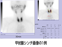 甲状腺シンチグラフィ Image description