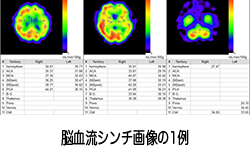 脳血流シンチグラフィ Image description