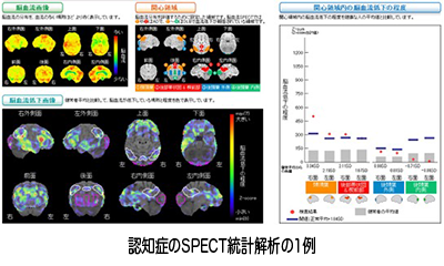 認知症のSPECT統計解析の1例 Image description