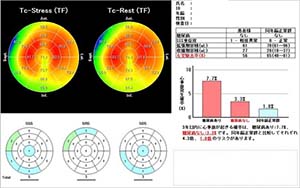 心筋血流シンチ Image description