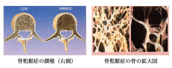 骨密度検査 Image description