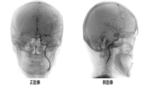 頭部(脳血管) Image description
