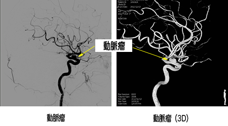 頭部(脳血管) Image description