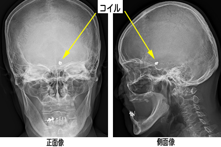 頭部(脳血管) Image description