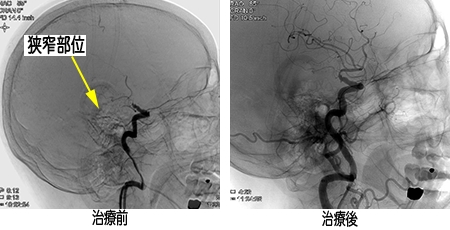 頭部(脳血管) Image description