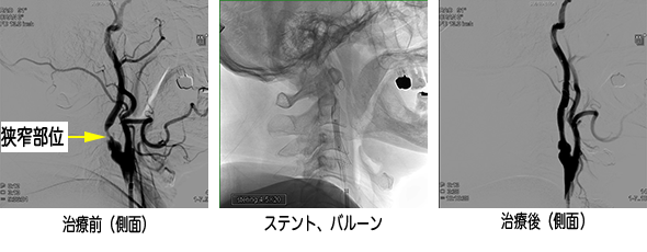 頭部(脳血管) Image description