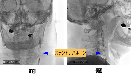頭部(脳血管) Image description