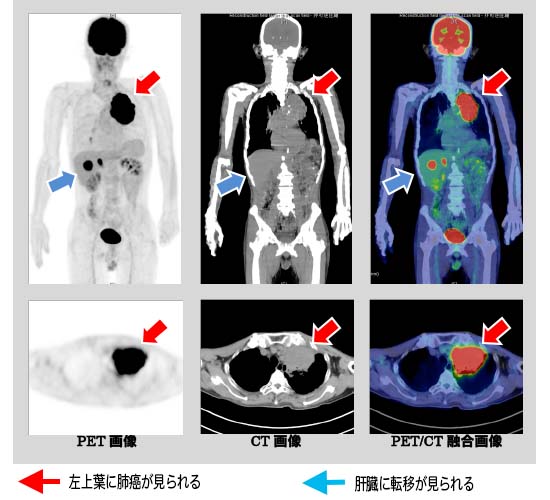 PET/CT画像 Image description