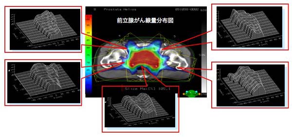 前立腺がん線量分布図 Image description