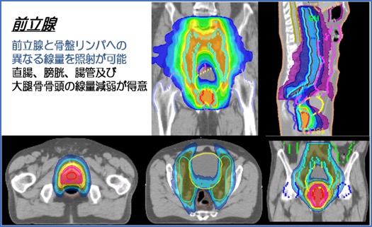 前立腺 臨床例 Image description