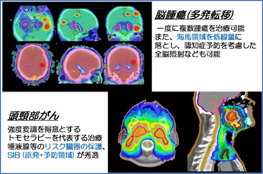 脳腫瘍・頭頸部がん 臨床例 Image description